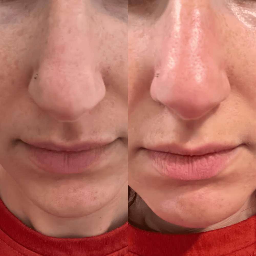 Peel Shot Coréen - Élimine les Impuretés et Sublime Votre Peau