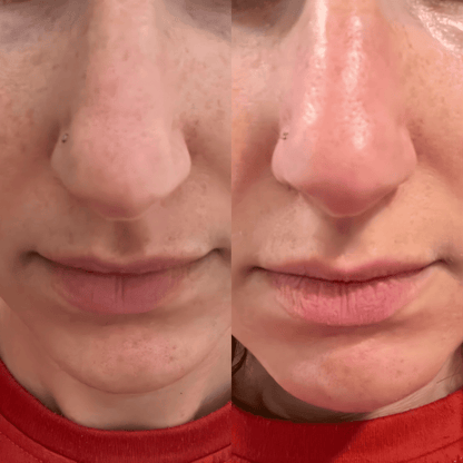 Peel Shot Coréen - Élimine les Impuretés et Sublime Votre Peau