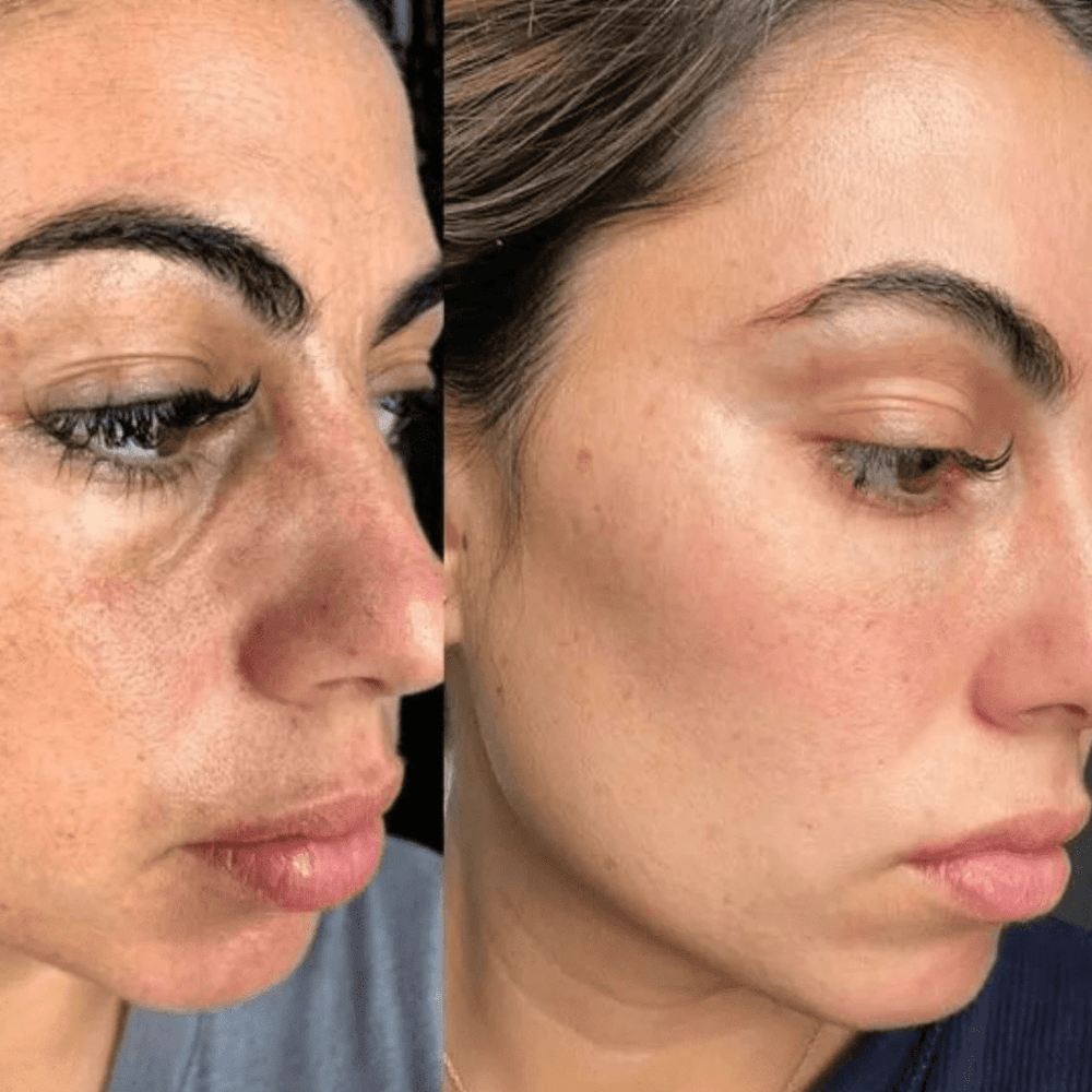 Peel Shot Coréen - Élimine les Impuretés et Sublime Votre Peau