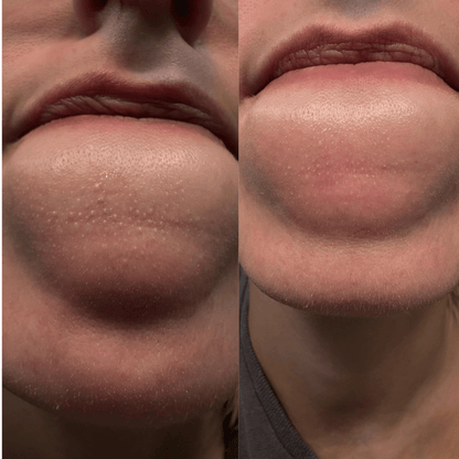 Peel Shot Coréen - Élimine les Impuretés et Sublime Votre Peau