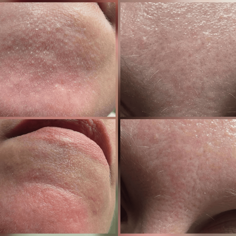 Peel Shot Coréen - Élimine les Impuretés et Sublime Votre Peau